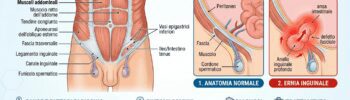 ernia inguinale infografica
