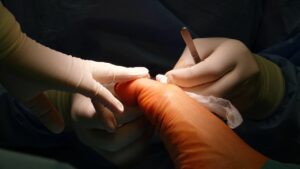 operazione unghia incarnita