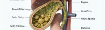 Illustrazione medica di calcoli all'interno della cistifellea.