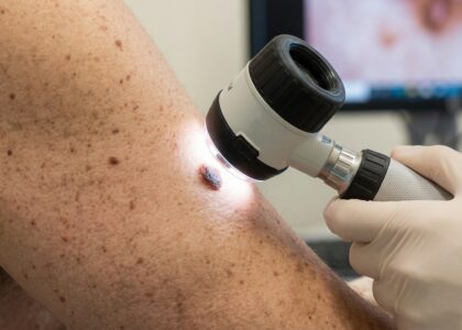 controllo dei nei tramite videodermatoscopia digitale