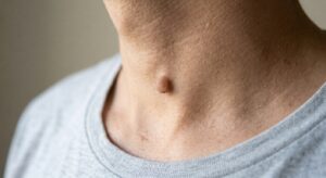 fibroma pendulo peduncolare su collo